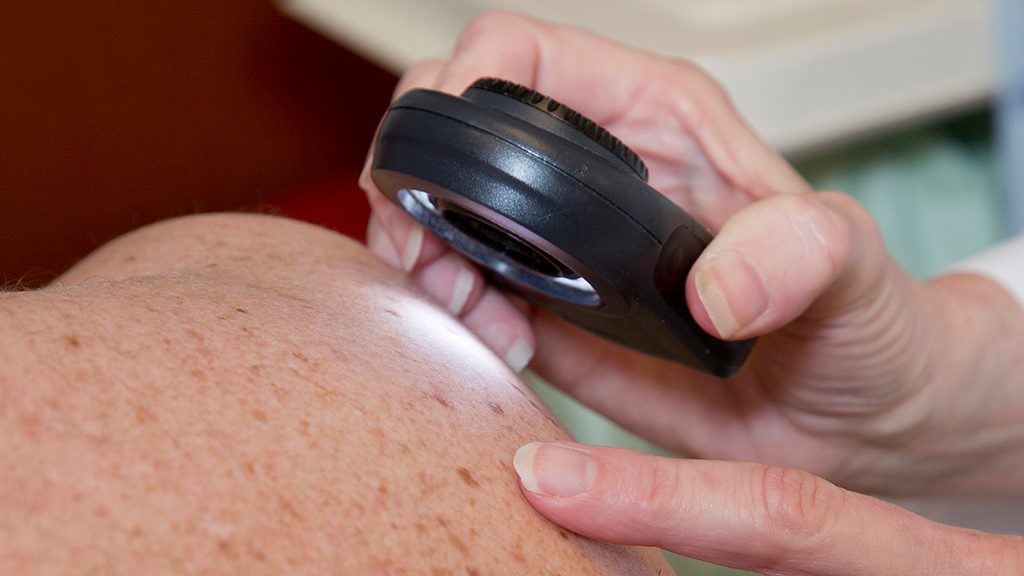 Close-up of skin cancer screening