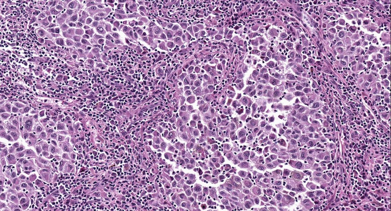 Metastatic melanoma