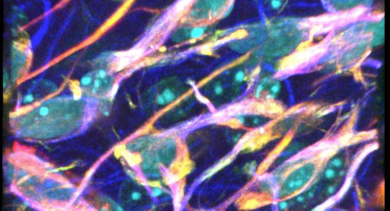Glioma cells that appear separate in two-dimensional imaging are actually connected