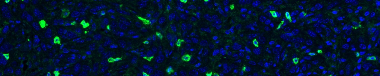 Infiltration of a pancreatic tumor by cytotoxic T cells (green) from an immunocompetent mouse that received the combination treatment with the glucocorticoid receptor antagonist (mifepristone) and dual immune checkpoint inhibitors (anti-PD1 + anti-CTLA-4).