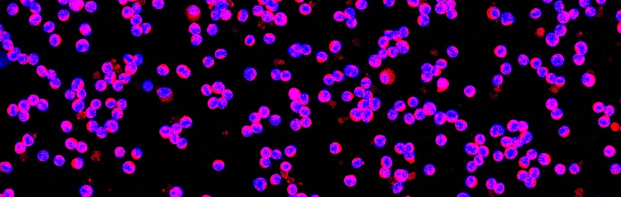 Image of the localization of protein arginine methyltransferase 5 ( in pink) in MLL-ENL leukemic cells (in blue)